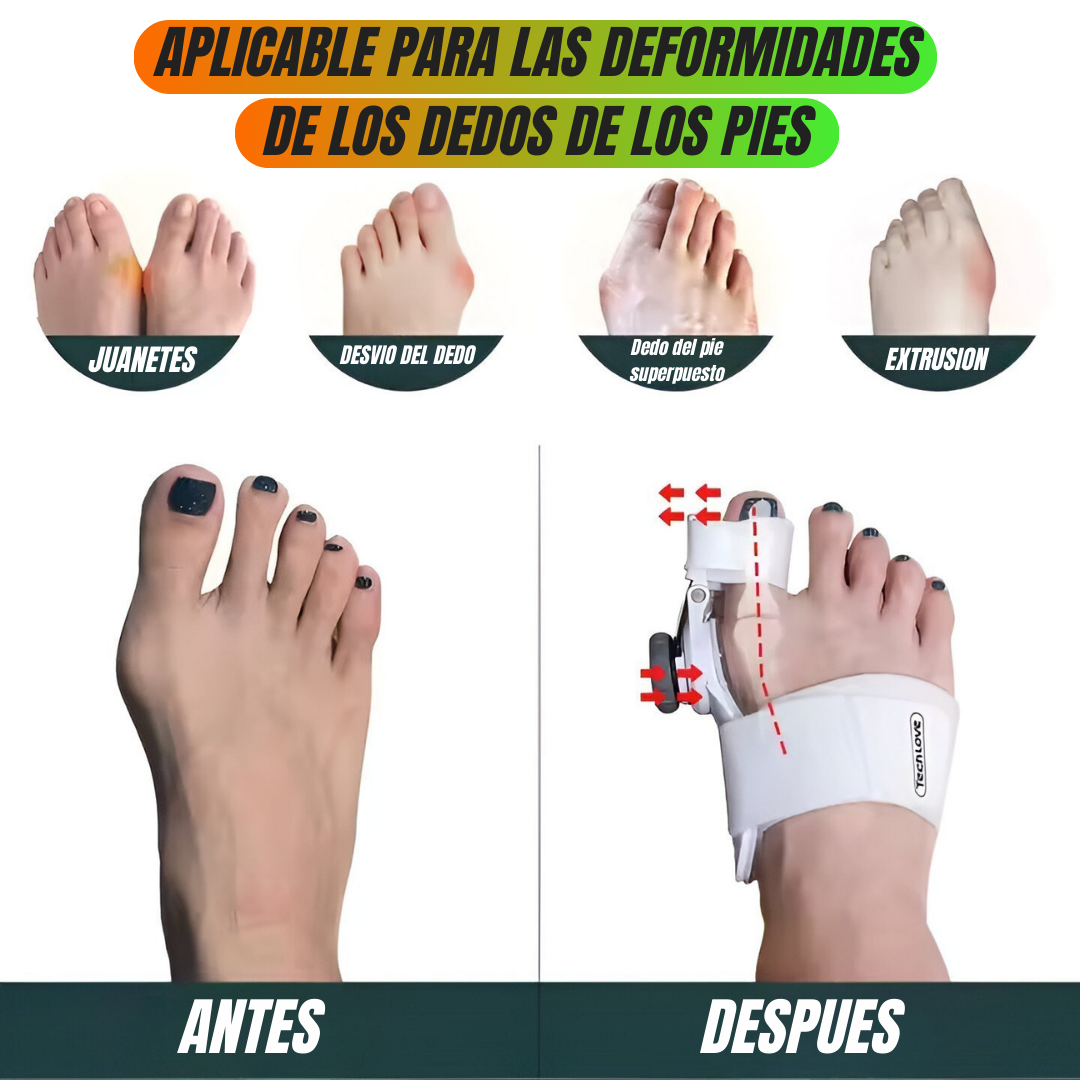 ✨ ¡Lleva tu Corrector Ortopédico para Juanetes por solo Q200 y recibe REGALOS EXCLUSIVOS + ENVÍO GRATIS! ✨